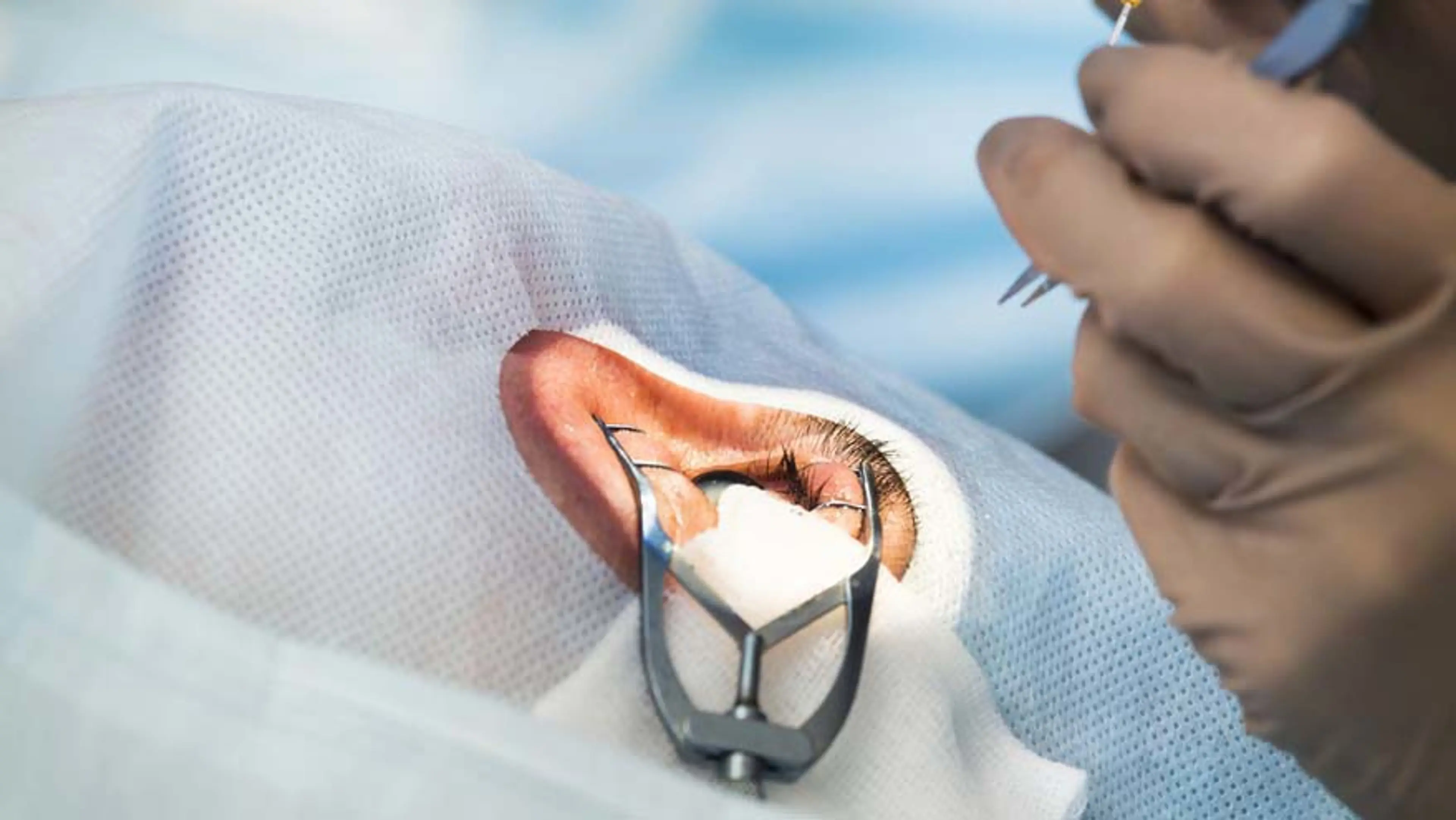 超声乳化白内障手术