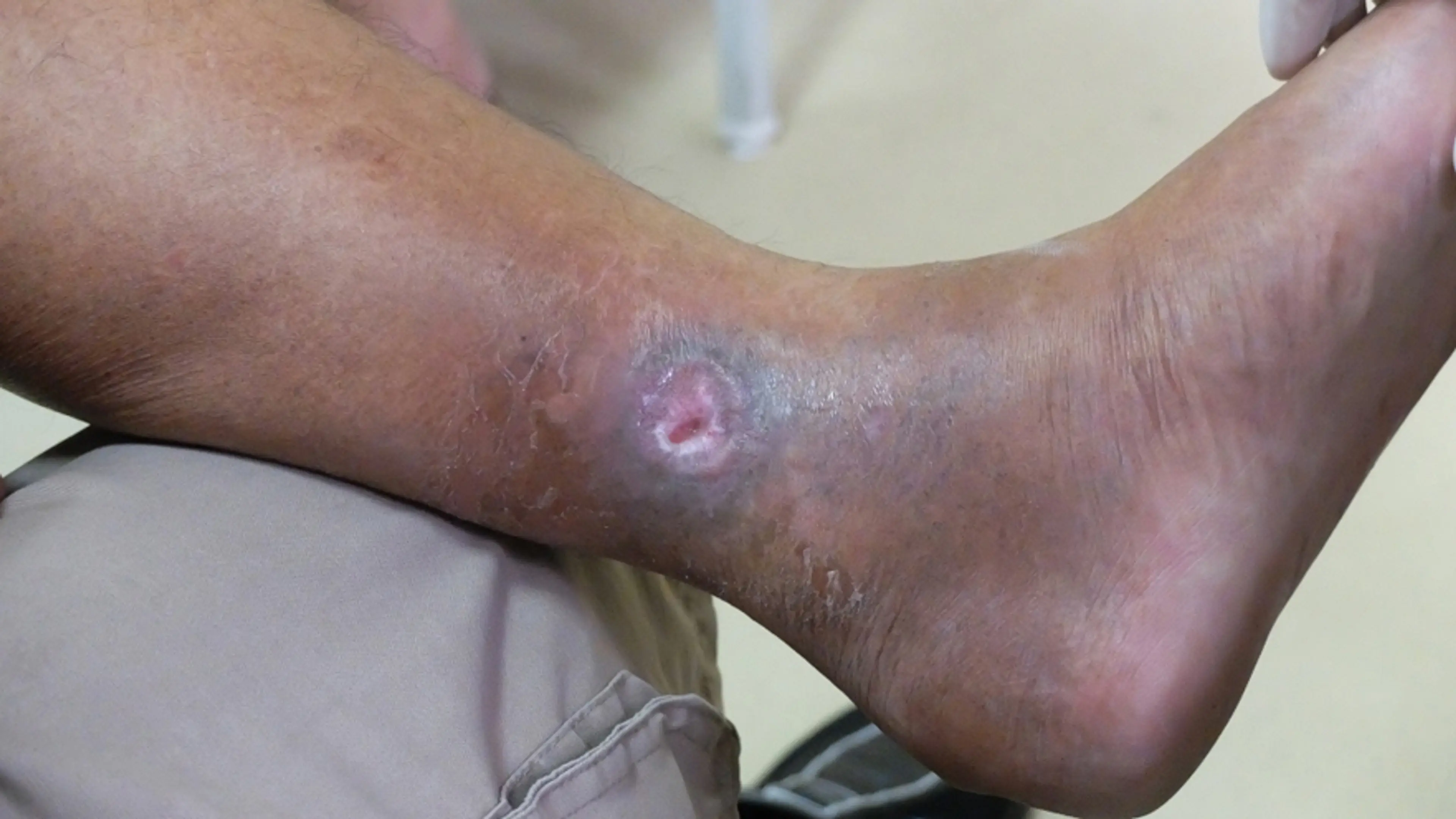 Varicose Vein