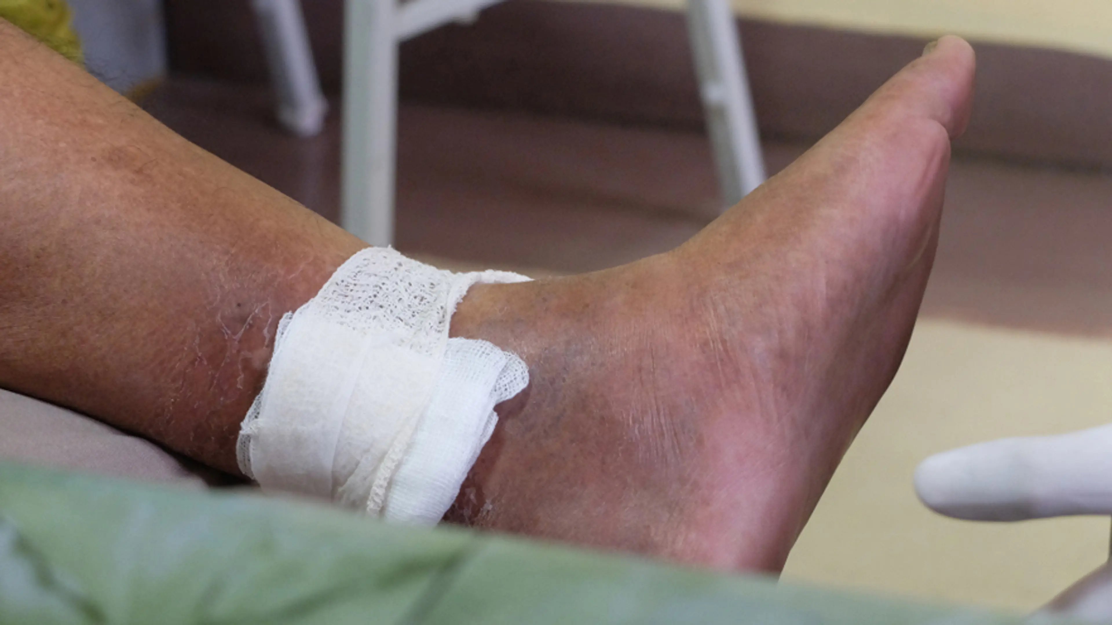 Varicose Vein Bleeding