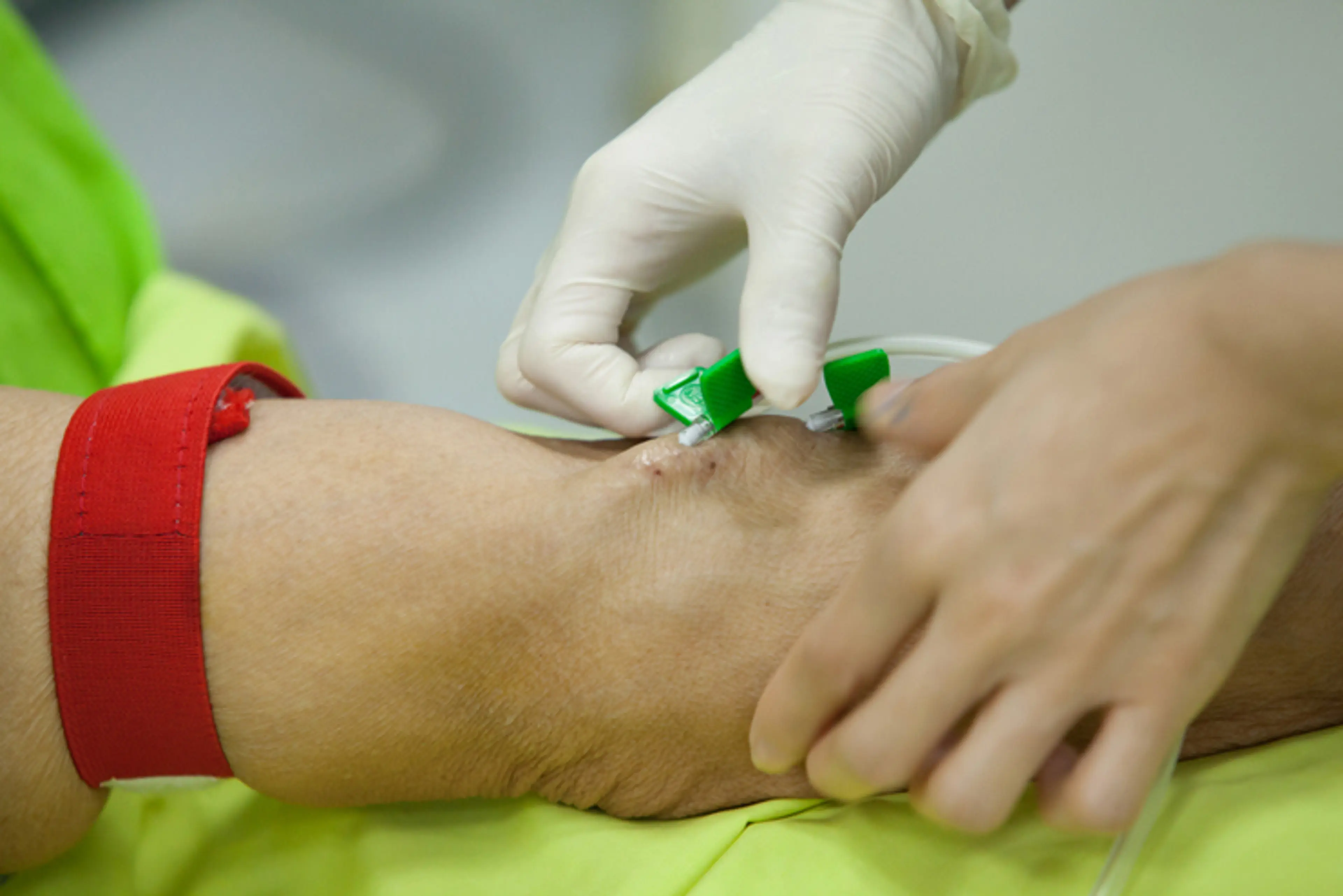 用于透析的动静脉瘘（AVF）