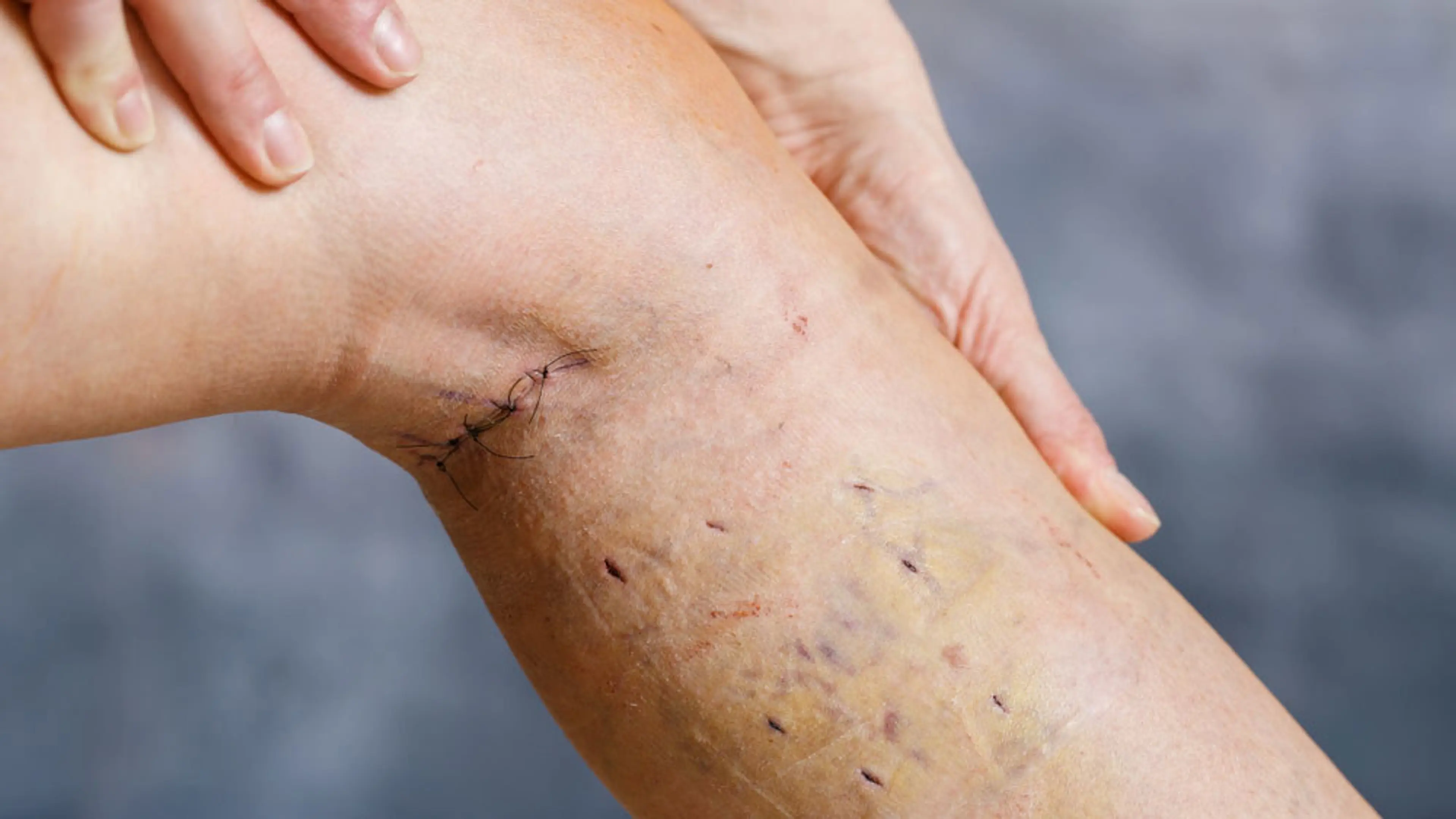 Buried Sutures Are Left Untreated