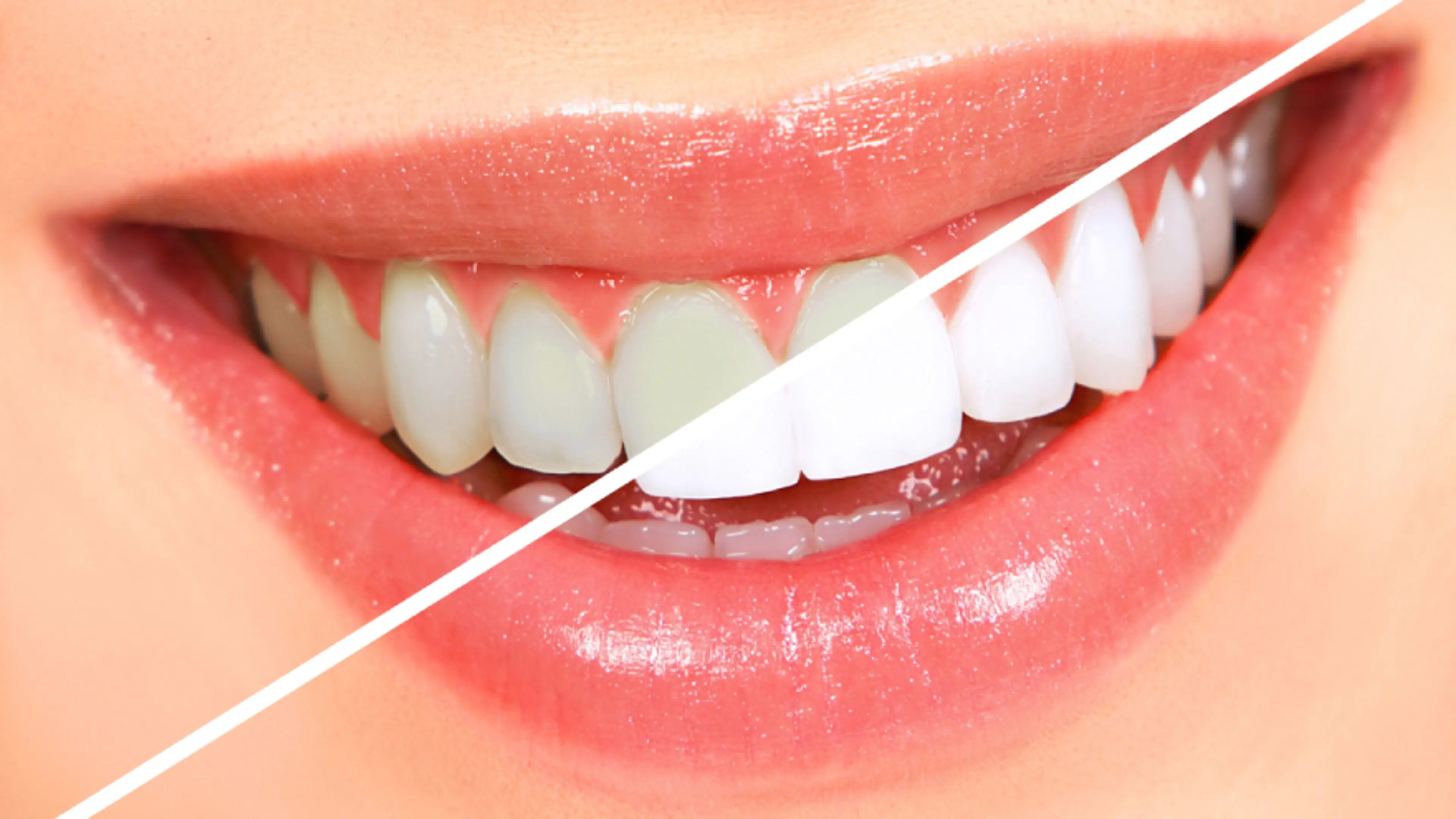 How to Choose Between Professional Teeth Whitening and Over-the-Counter ...
