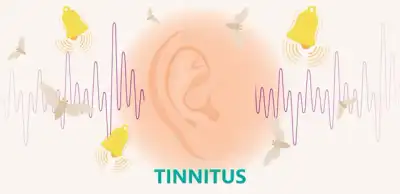 Tinnitus