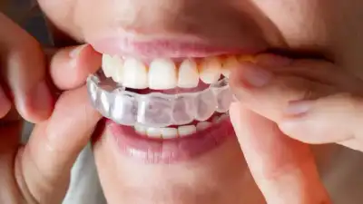 Invisible Aligner