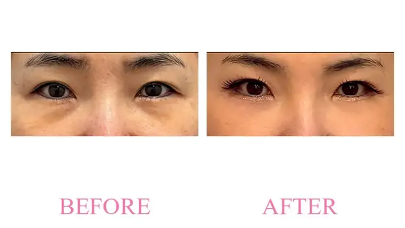 Before and after treatment result at Dojagi Clinic