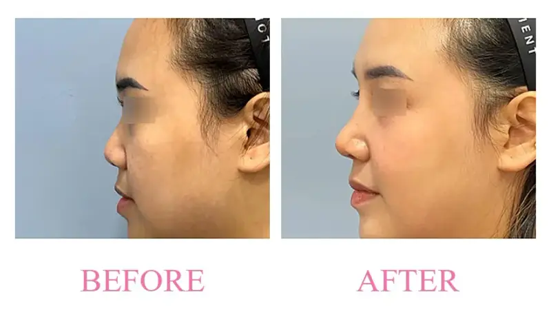 Before and after treatment result at Dojagi Clinic