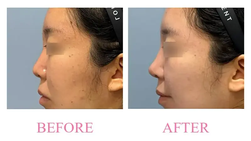 Before and after treatment result at Dojagi Clinic