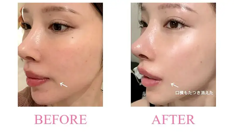 Before and after treatment result at Dojagi Clinic