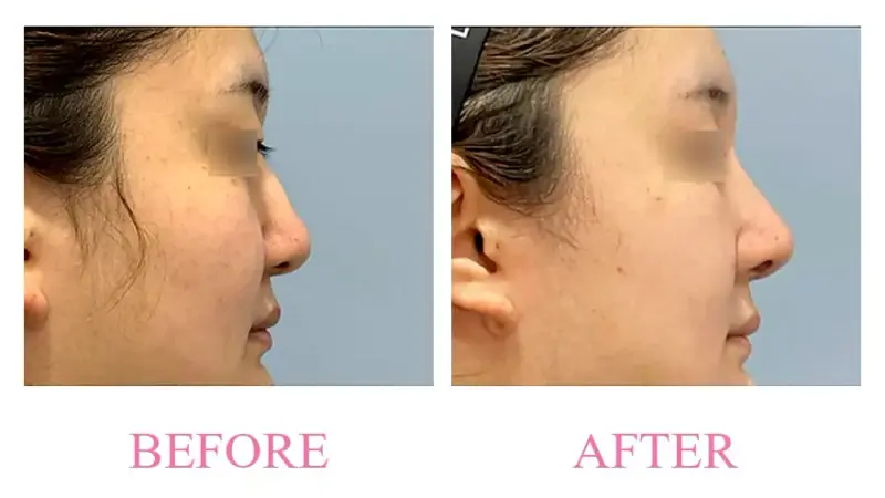Before and after treatment result at Dojagi Clinic