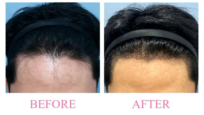 Before and after treatment result at Dojagi Clinic