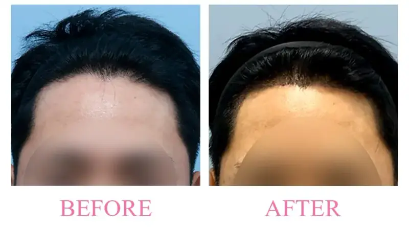 Before and after treatment result at Dojagi Clinic