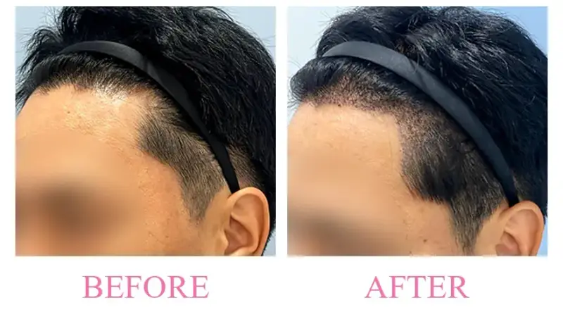 Before and after treatment result at Dojagi Clinic