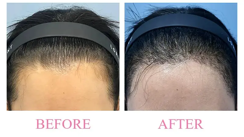 Before and after treatment result at Dojagi Clinic
