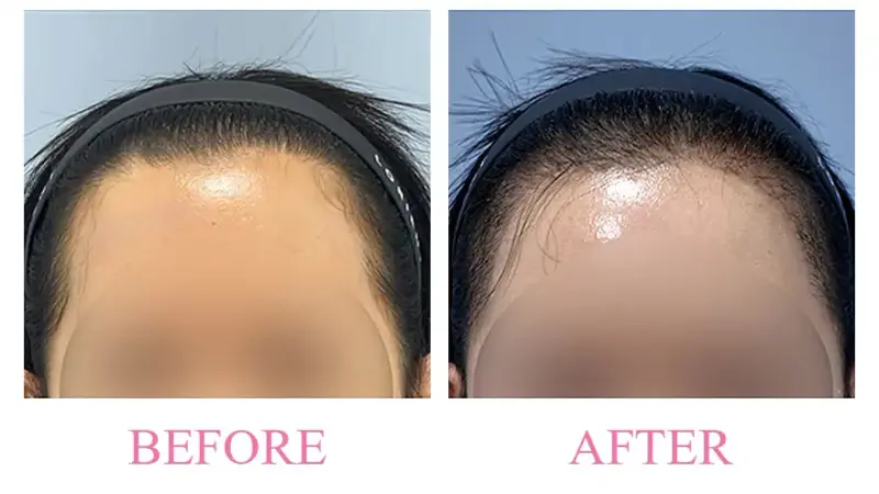 Before and after treatment result at Dojagi Clinic
