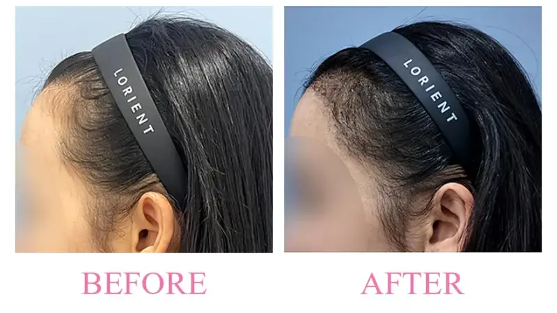 Before and after treatment result at Dojagi Clinic