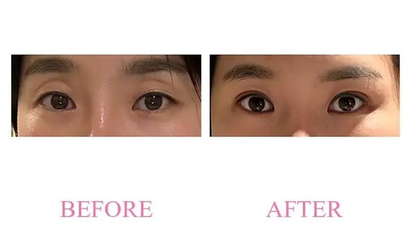 Before and after treatment result at Dojagi Clinic